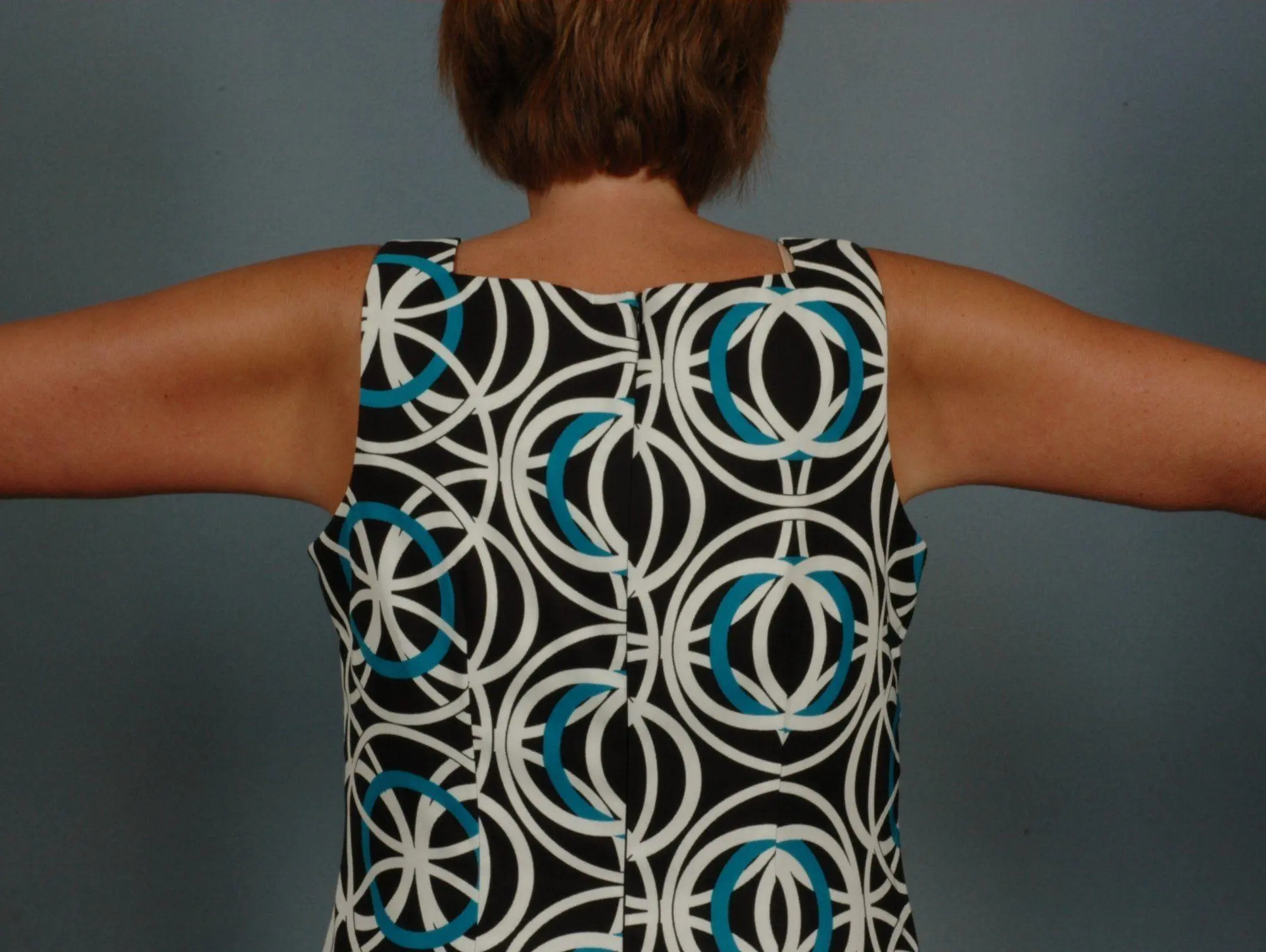 Arm Lift Patient Photo - Case 12392 - after view