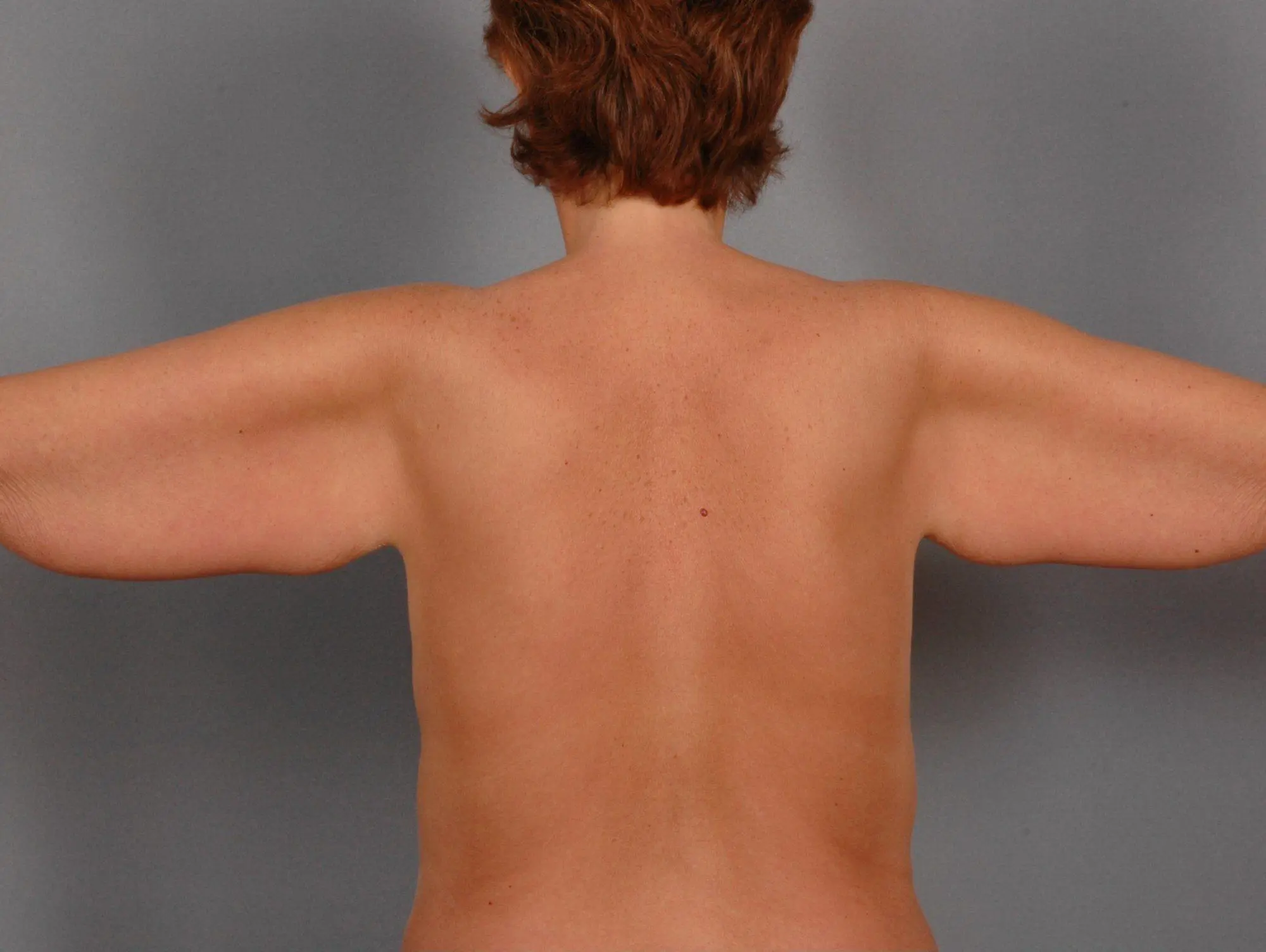 Arm Lift Patient Photo - Case 12392 - before view-