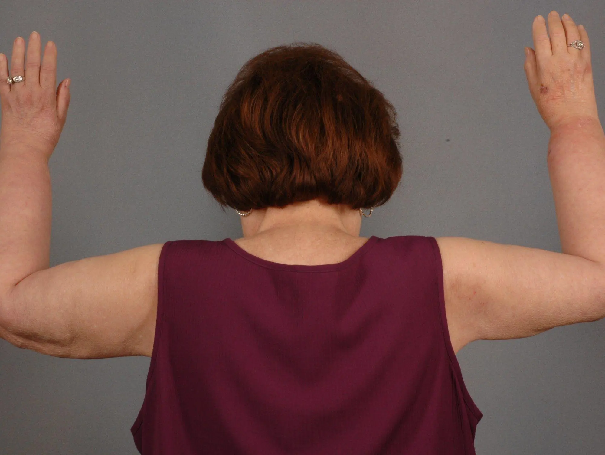 Arm Lift Patient Photo - Case 12400 - after view