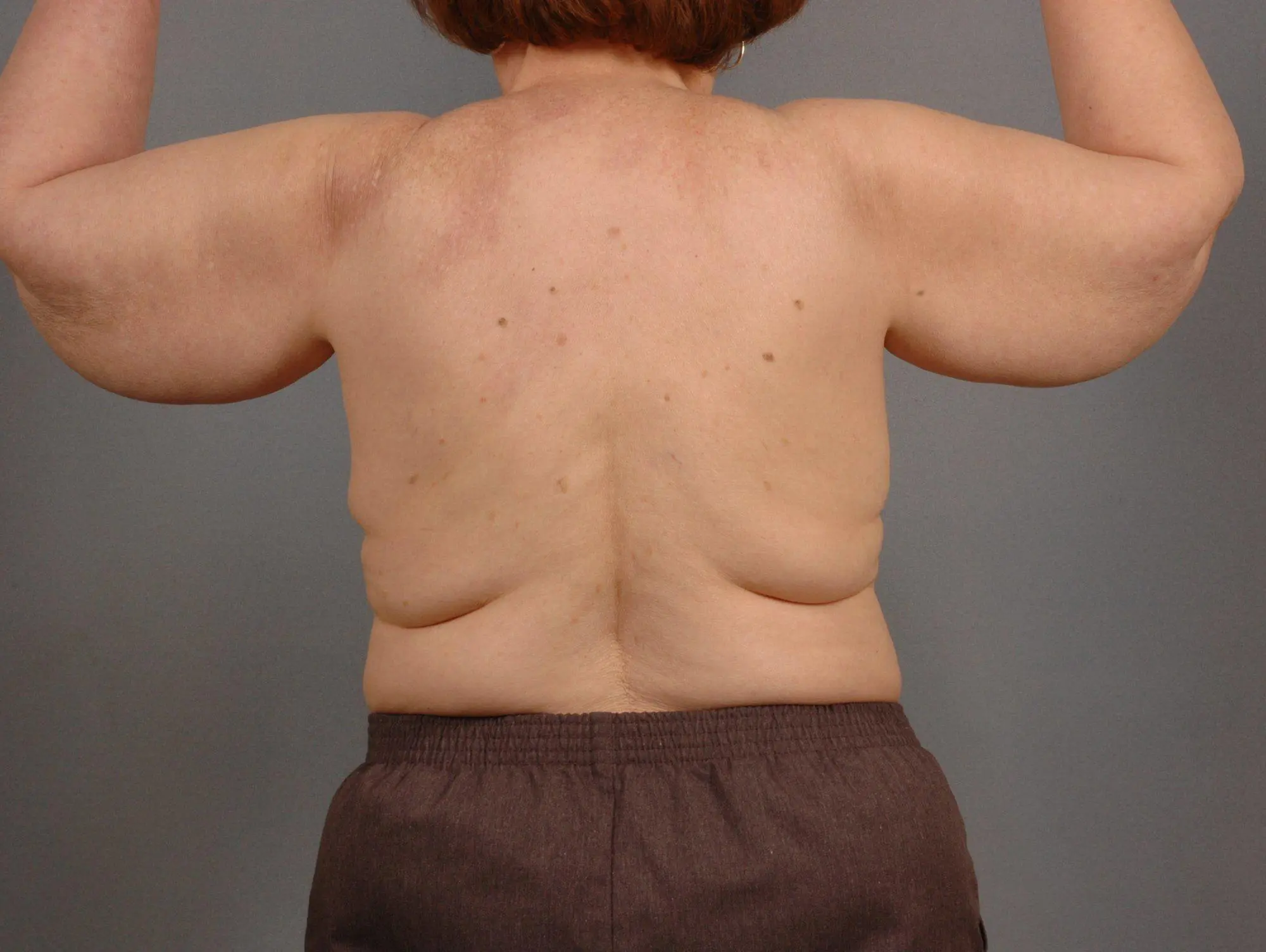 Arm Lift Patient Photo - Case 12400 - before view-