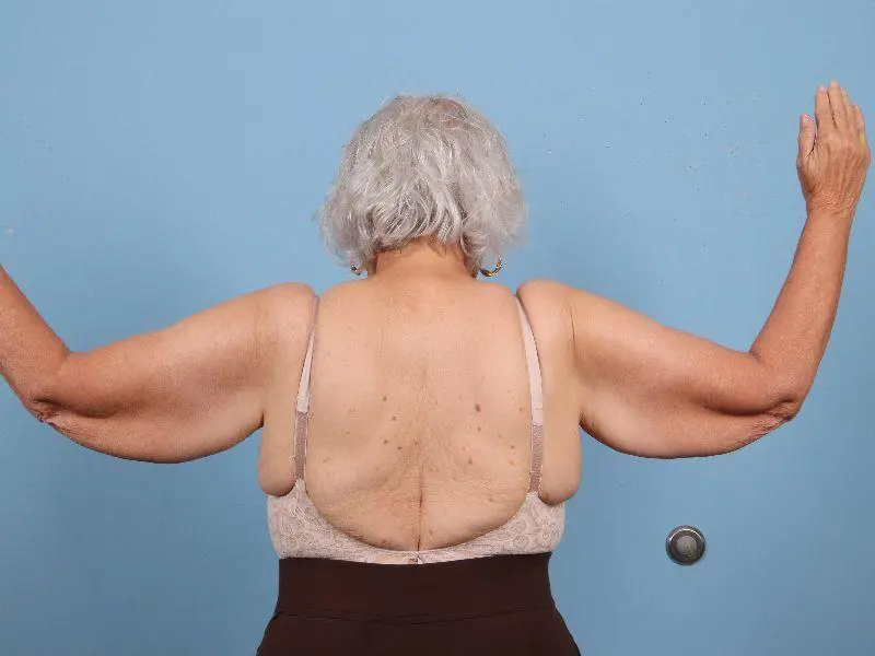 Arm Lift Patient Photo - Case 12466 - before view-1