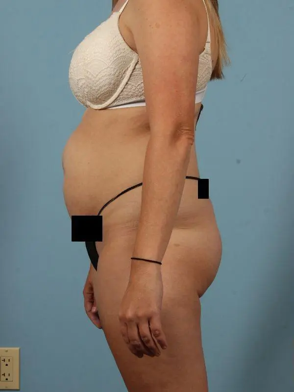 Brazilian Butt Lift Patient Photo - Case 12493 - before view-1