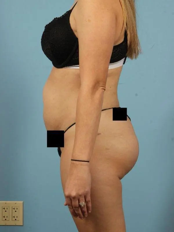 Brazilian Butt Lift Patient Photo - Case 12493 - after view-1