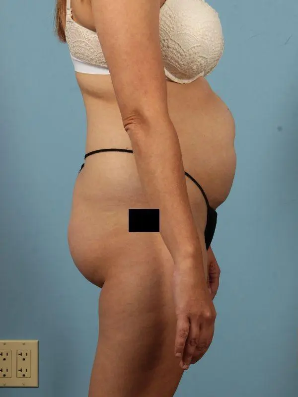 Brazilian Butt Lift Patient Photo - Case 12493 - before view-2