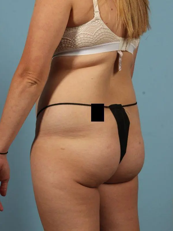 Brazilian Butt Lift Patient Photo - Case 12493 - before view-3