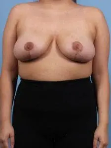 Breast Reduction - Case 13437 - After