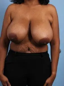 Breast Reduction - Case 13461 - Before