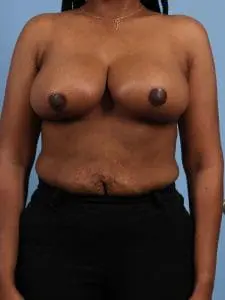Breast Reduction - Case 13461 - After