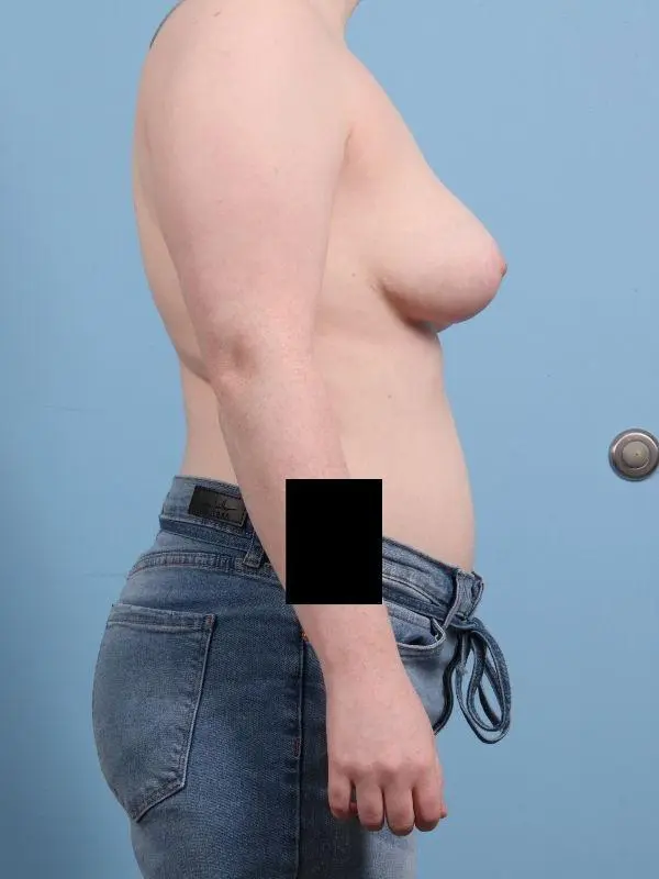 Breast Reduction Patient Photo - Case 13473 - after view-2