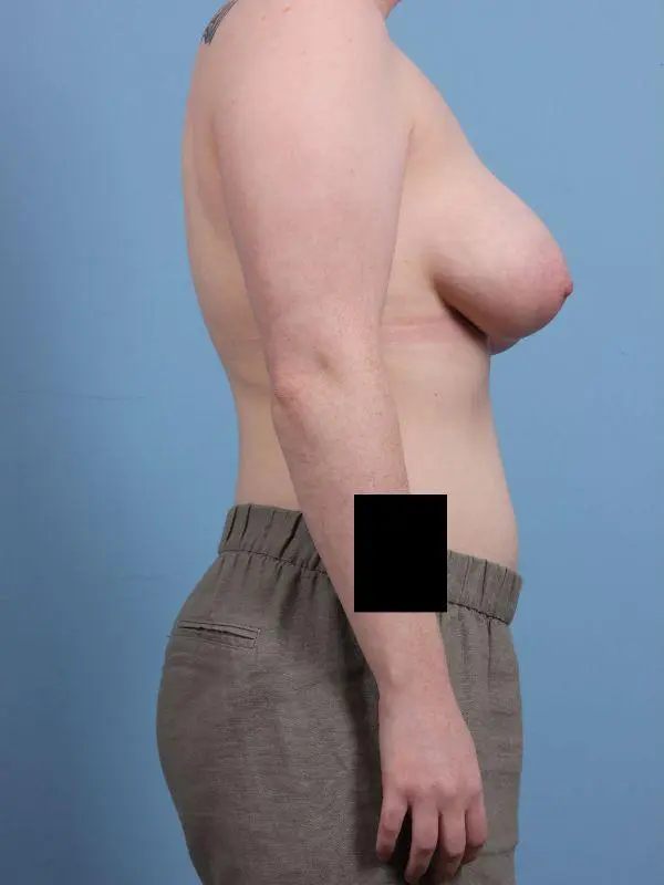Breast Reduction Patient Photo - Case 13473 - before view-2