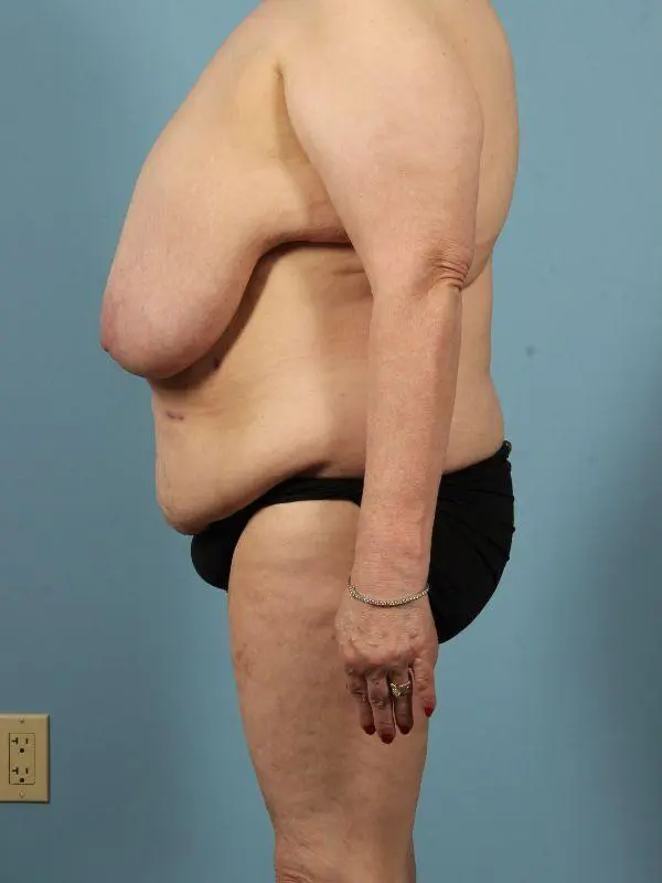 Breast Reduction Patient Photo - Case 13486 - before view-1