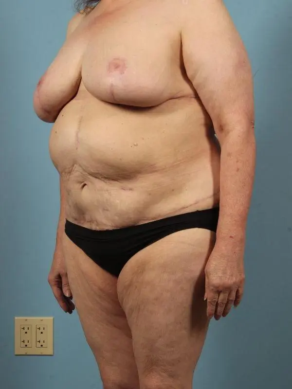 Breast Reduction Patient Photo - Case 13486 - after view-3