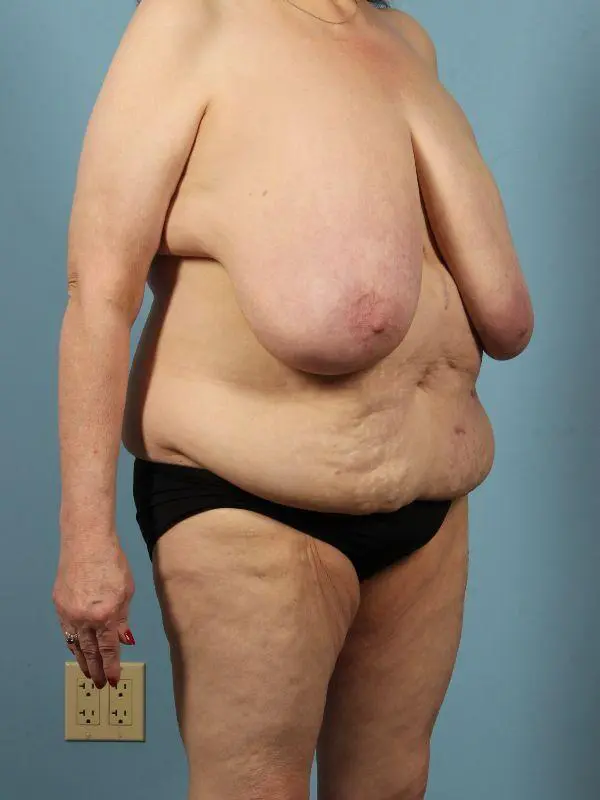 Breast Reduction Patient Photo - Case 13486 - before view-4