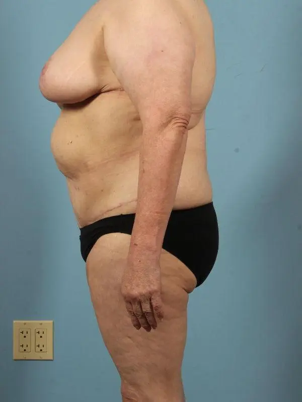 Breast Reduction Patient Photo - Case 13486 - after view-1