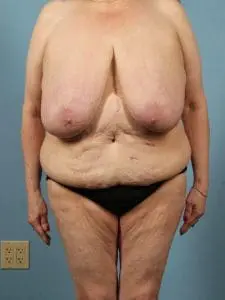 Breast Reduction - Case 13486 - Before