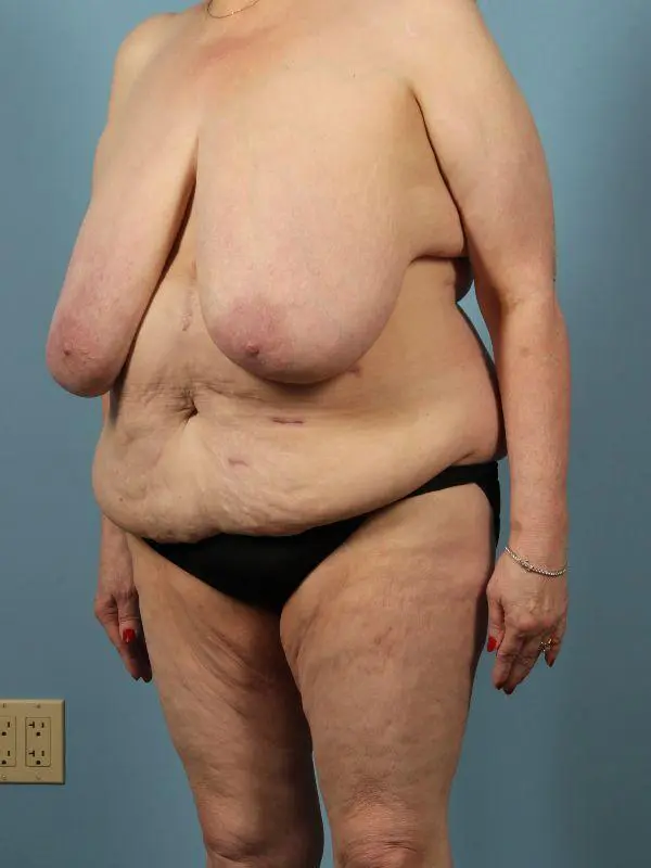 Breast Reduction Patient Photo - Case 13486 - before view-3