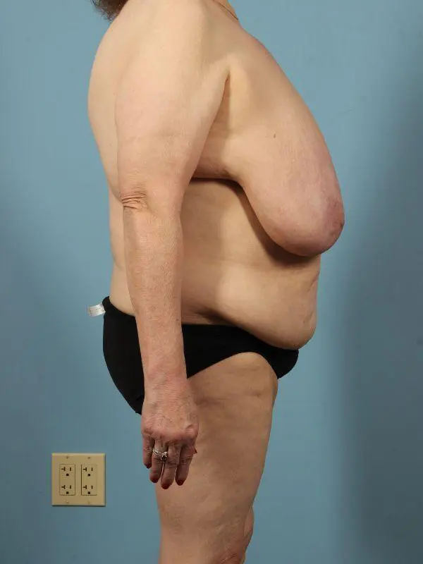 Breast Reduction Patient Photo - Case 13486 - before view-2