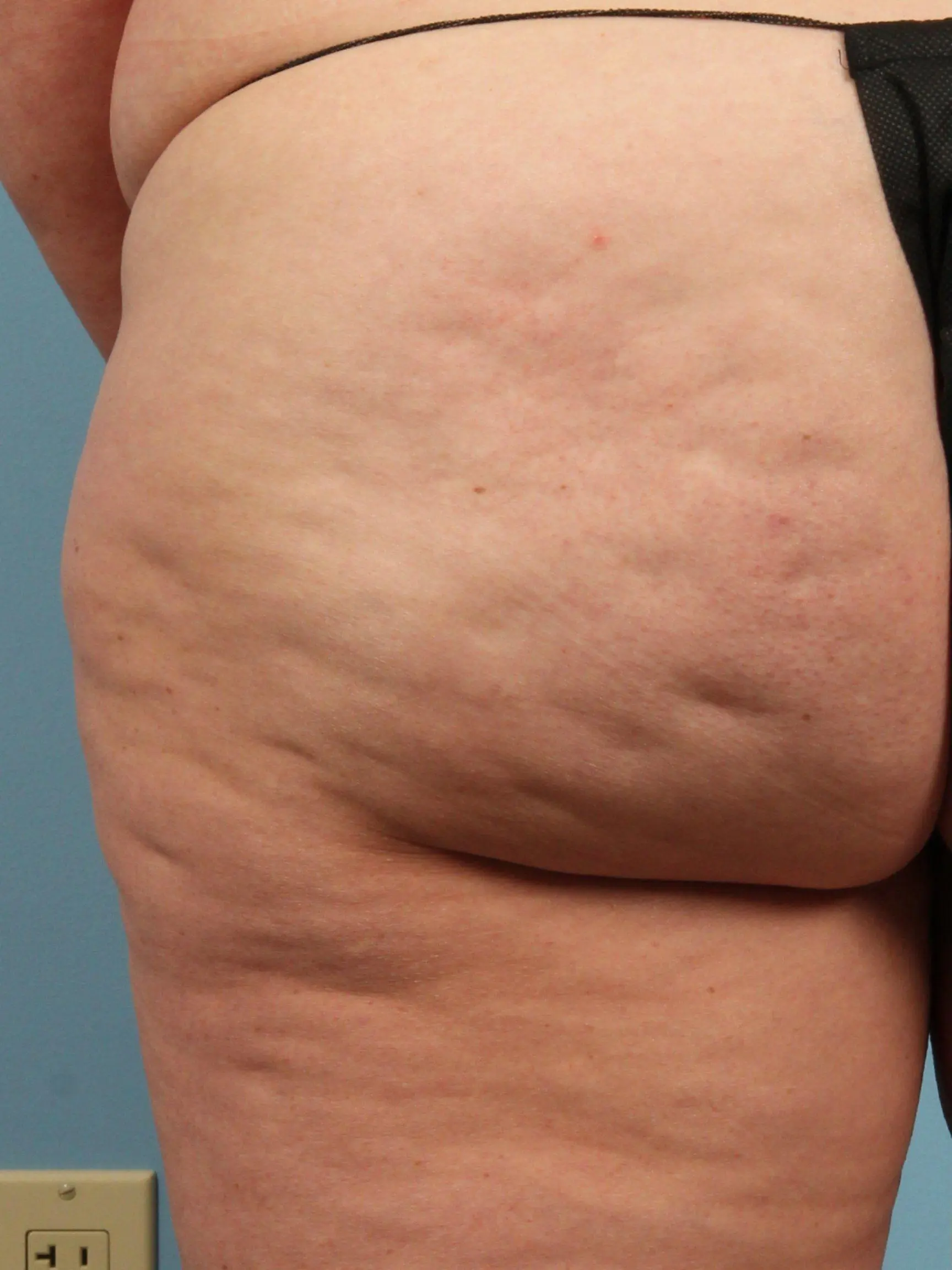 Cellulite Reduction Patient Photo - Case 13498 - before view-1