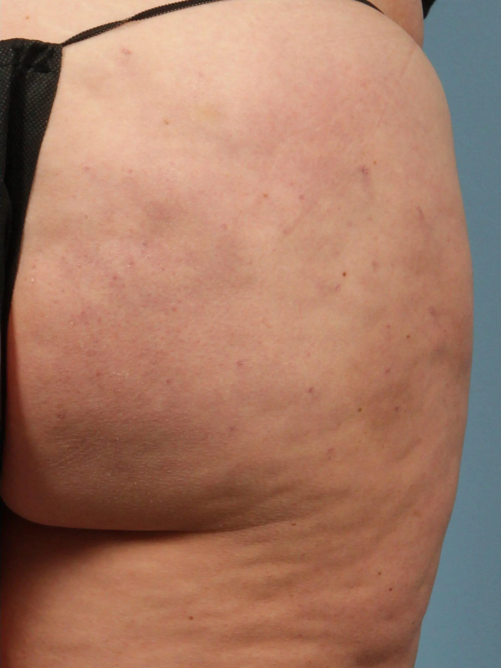 Cellulite Reduction Patient Photo - Case 13498 - after view
