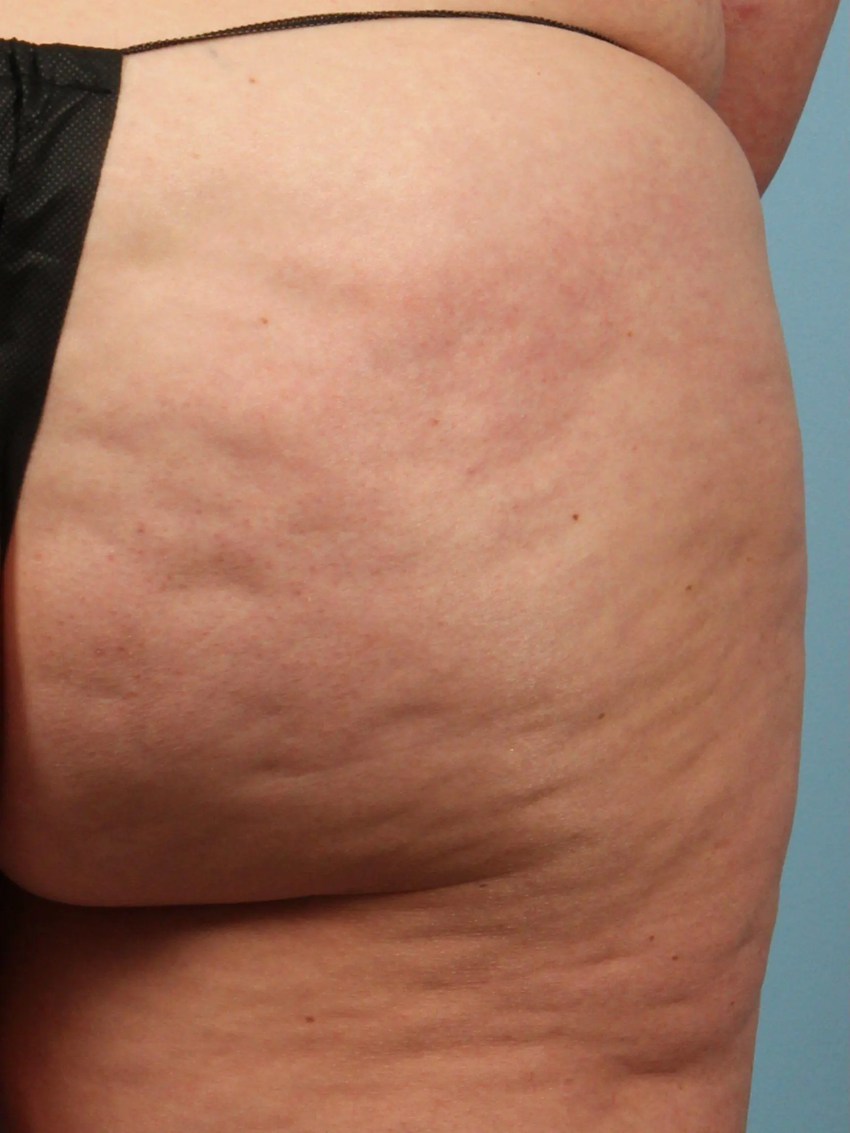 Cellulite Reduction Patient Photo - Case 13498 - before view-