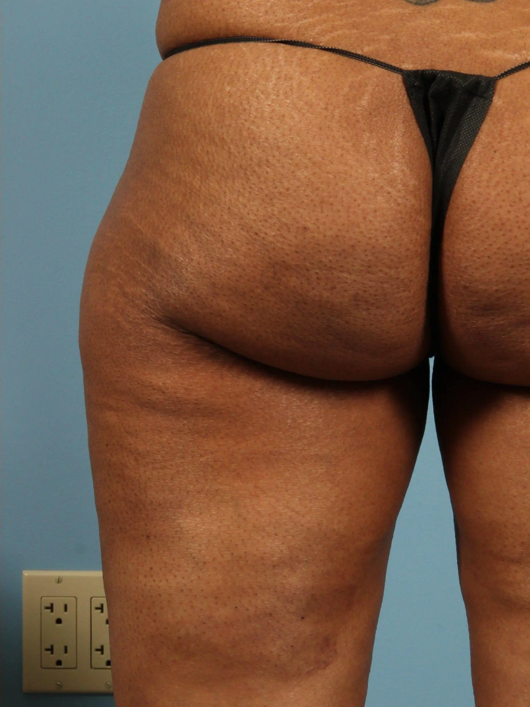 Cellulite Reduction Patient Photo - Case 13505 - after view-2