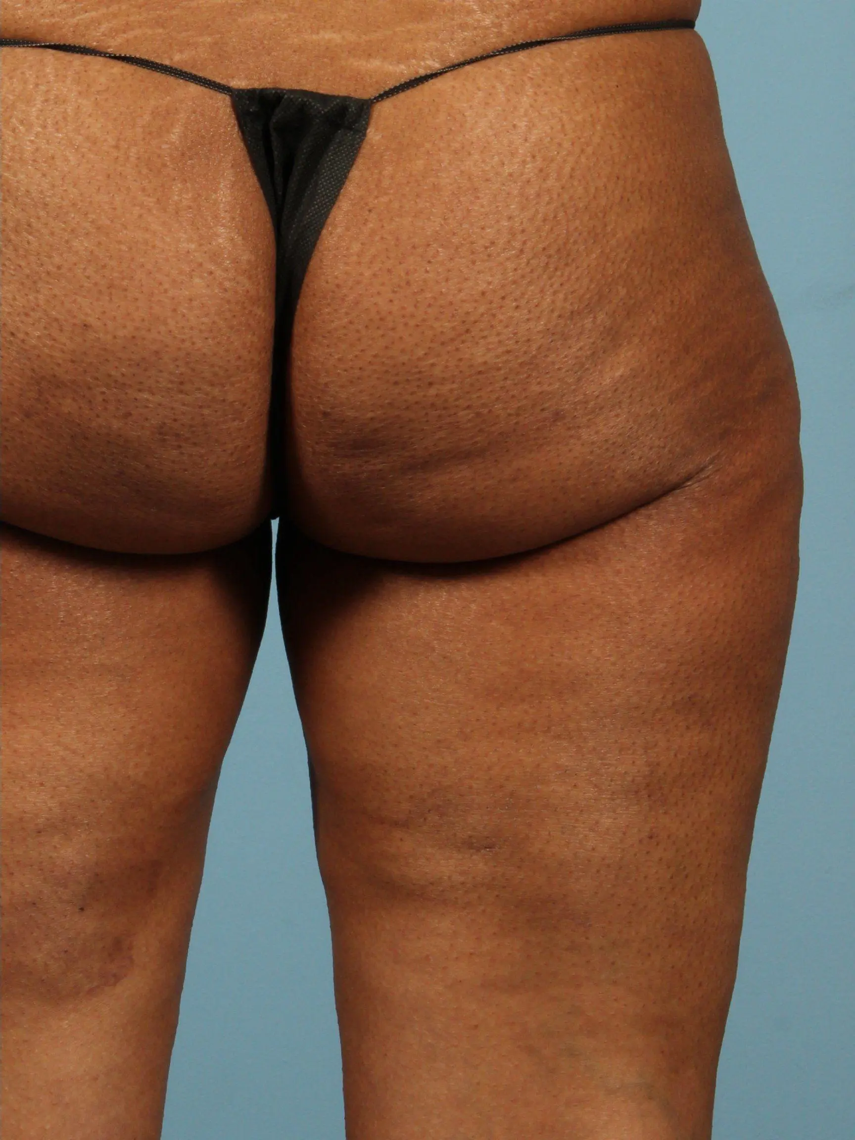 Cellulite Reduction Patient Photo - Case 13505 - after view-1