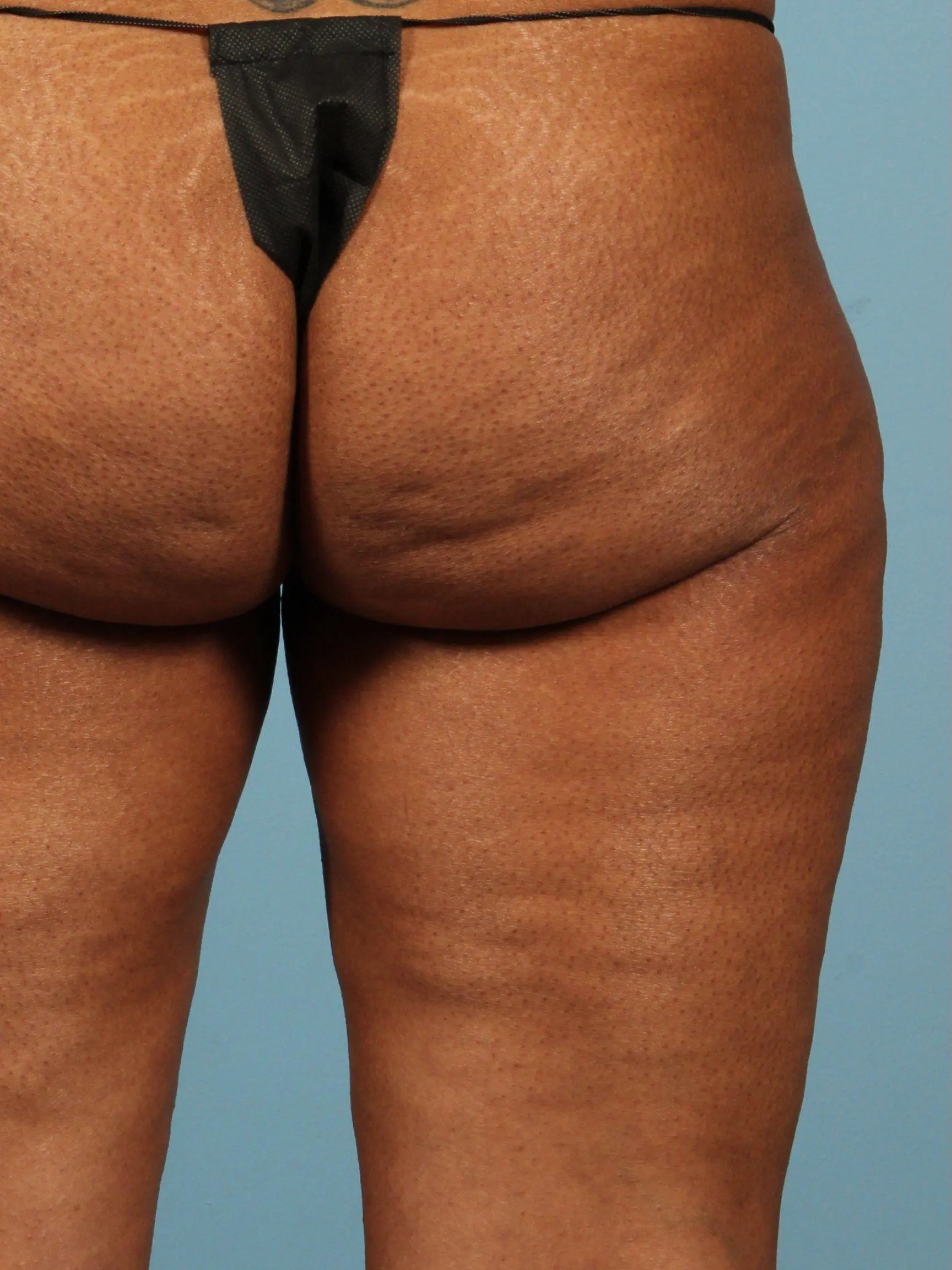 Cellulite Reduction Patient Photo - Case 13505 - before view-1