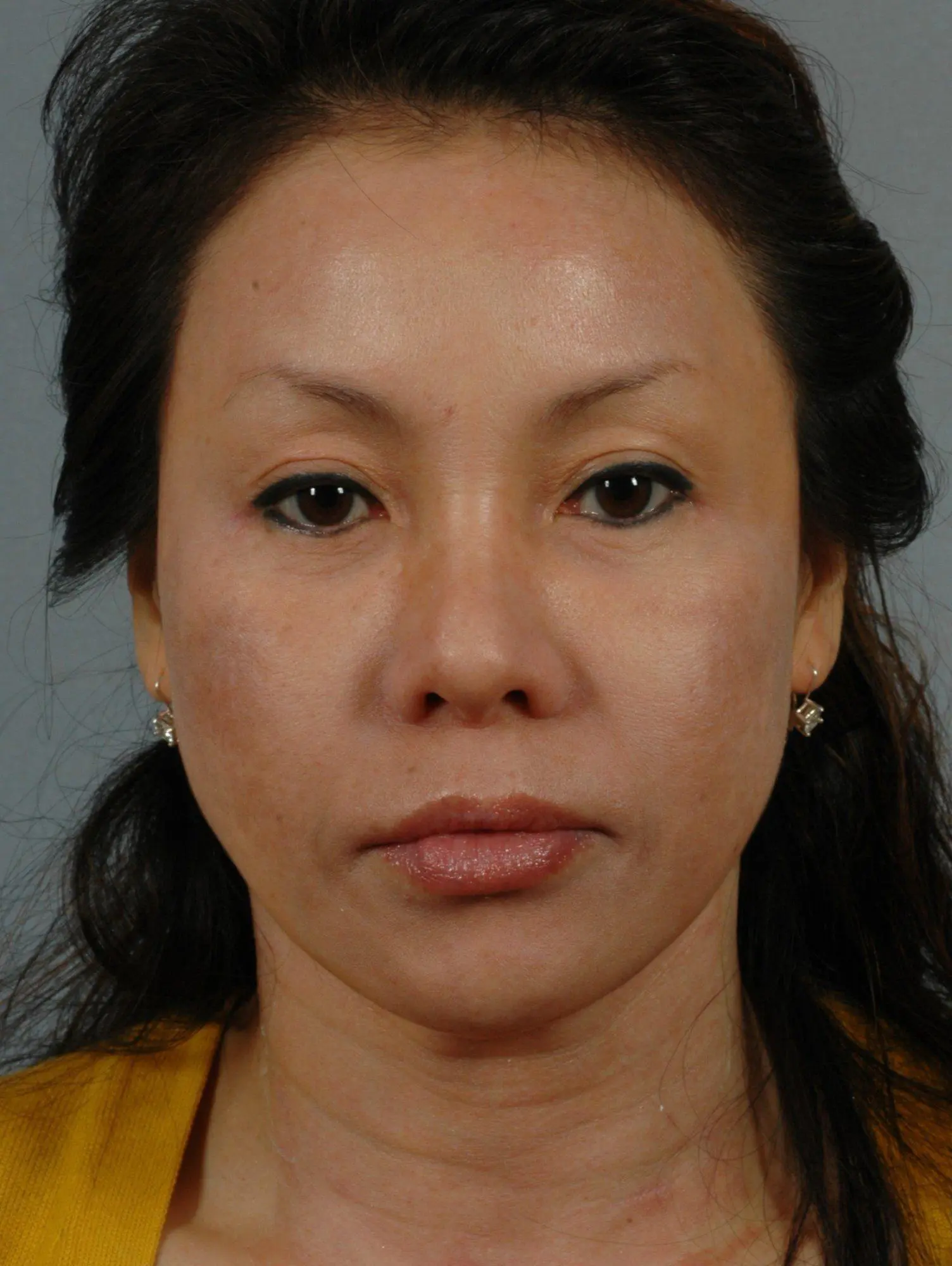 Chin Augmentation Patient Photo - Case 13700 - before view-