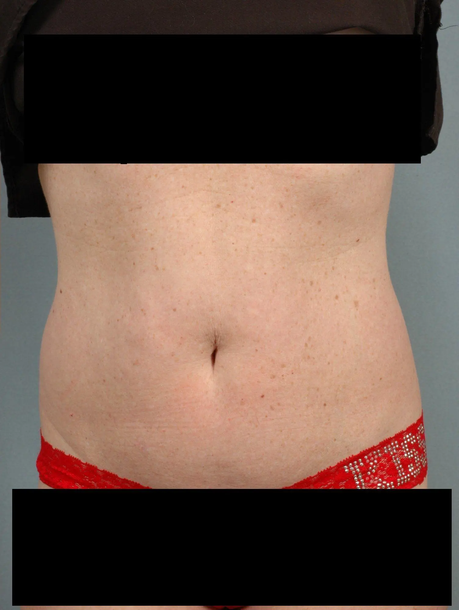 CoolSculpting Patient Photo - Case 13718 - after view