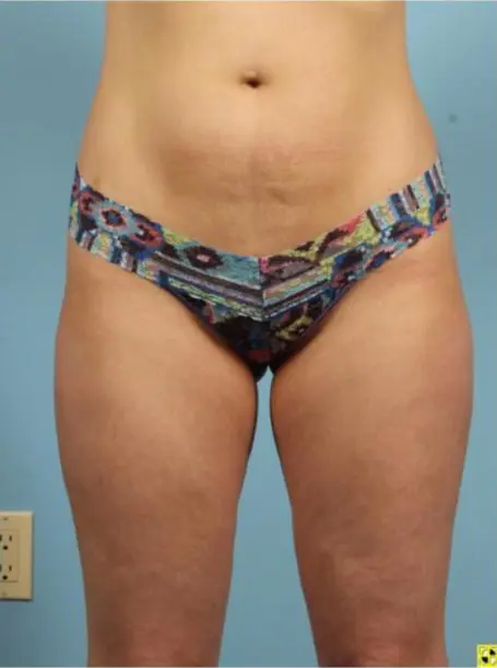 CoolSculpting Patient Photo - Case 13783 - after view