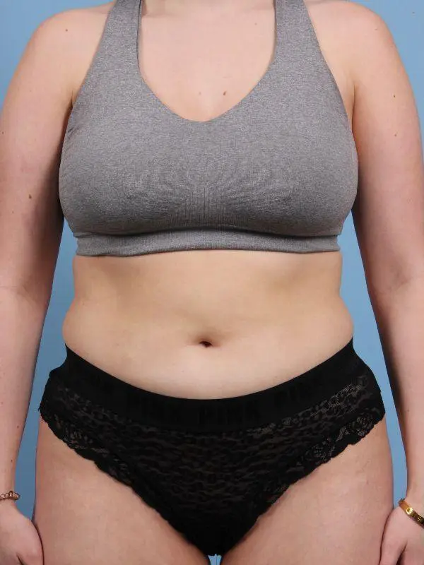 CoolSculpting Patient Photo - Case 13931 - before view-