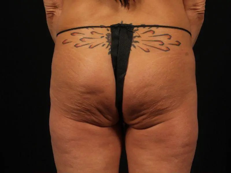 EMSCULPT Patient Photo - Case 14004 - before view-