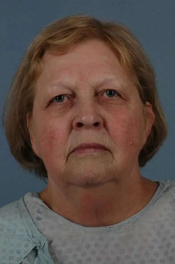 Eyelid Surgery Patient Photo - Case 14064 - before view-