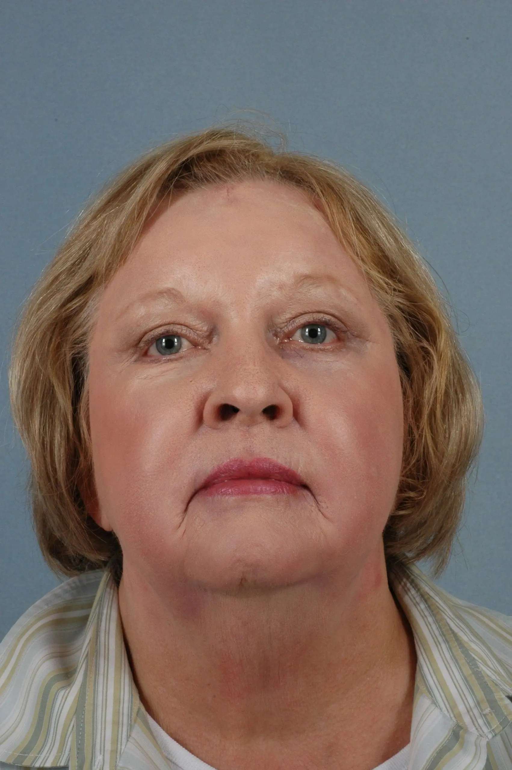 Eyelid Surgery Patient Photo - Case 14064 - after view