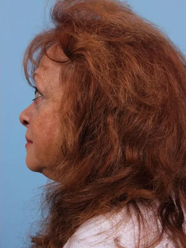 Eyelid Surgery Patient Photo - Case 14099 - after view-1