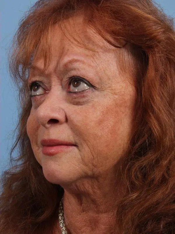 Eyelid Surgery Patient Photo - Case 14099 - after view-3