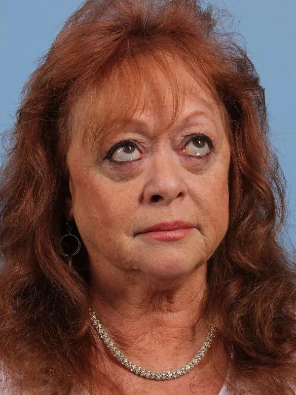 Eyelid Surgery Patient Photo - Case 14099 - after view-4