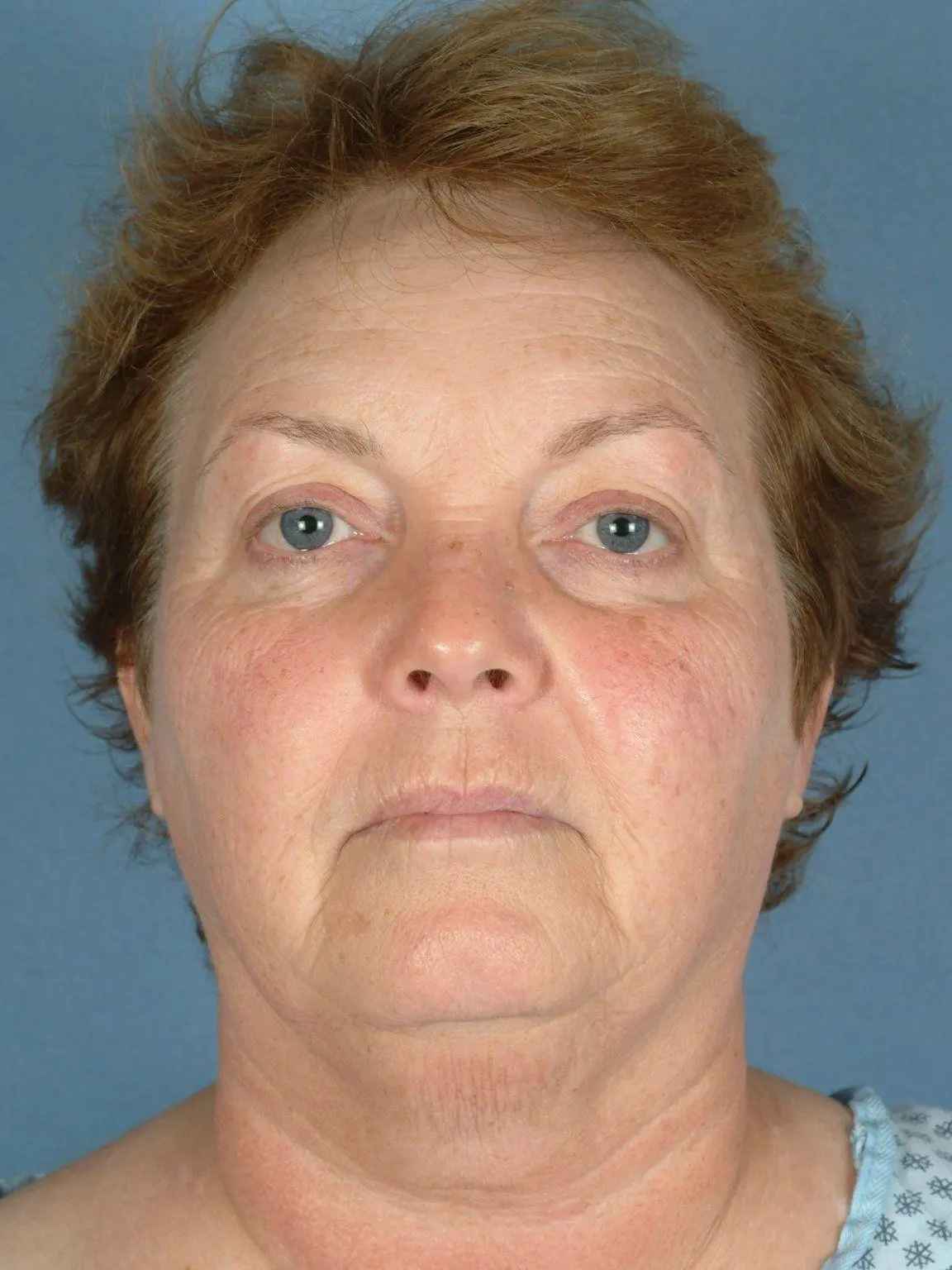 Facelift Patient Photo - Case 14156 - before view-