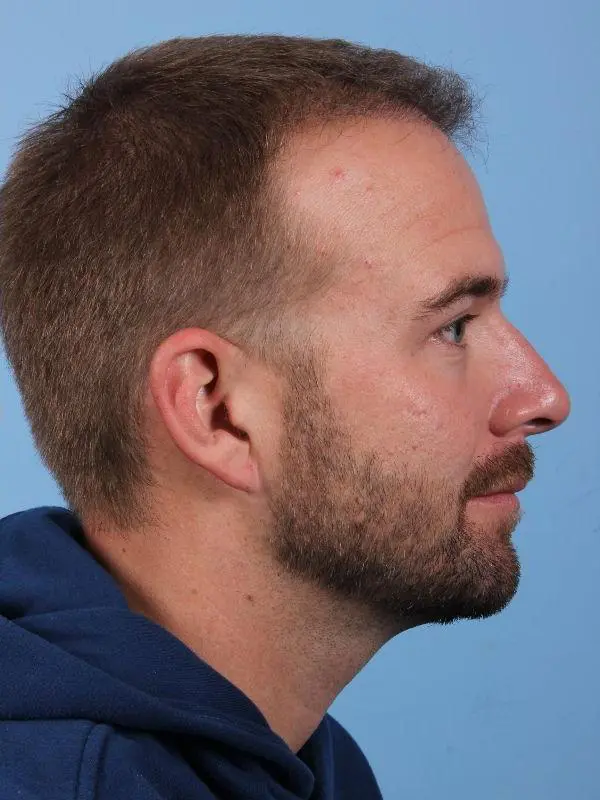 Hair Restoration Patient Photo - Case 14332 - after view-2