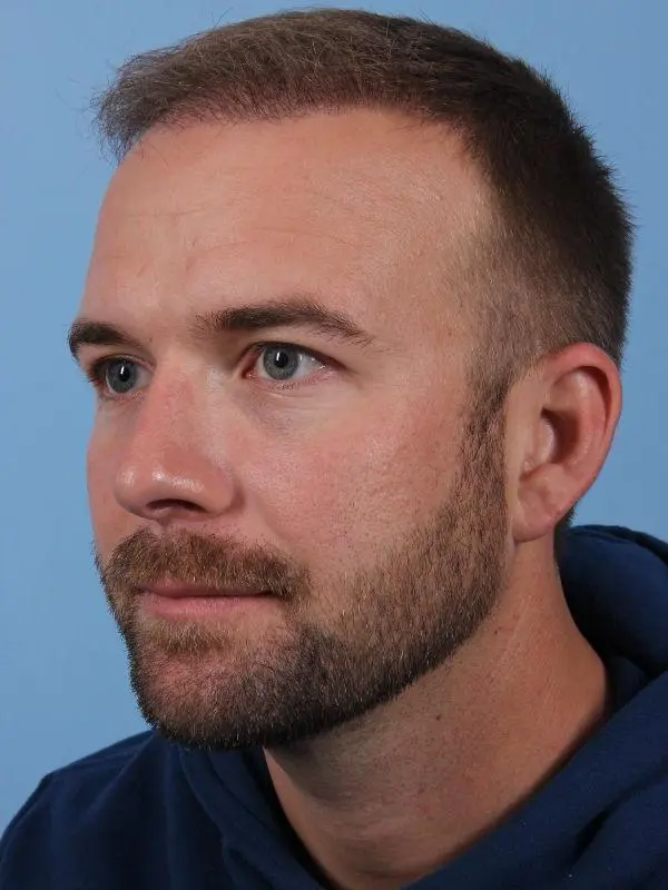 Hair Restoration Patient Photo - Case 14332 - after view-3