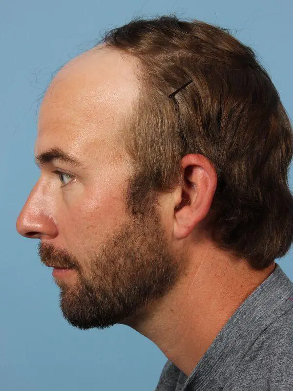 Hair Restoration Patient Photo - Case 14332 - before view-1