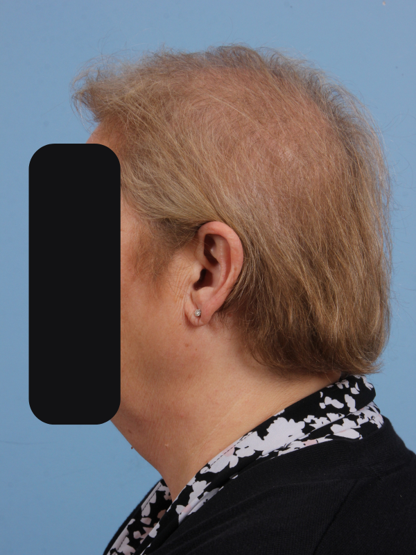 Hair Restoration Patient Photo - Case 14348 - before view-1