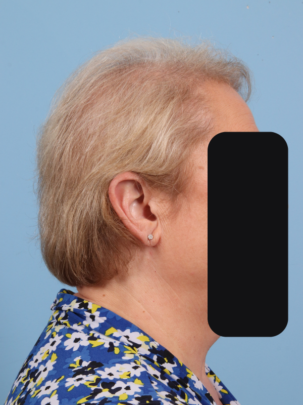 Hair Restoration Patient Photo - Case 14348 - after view-2