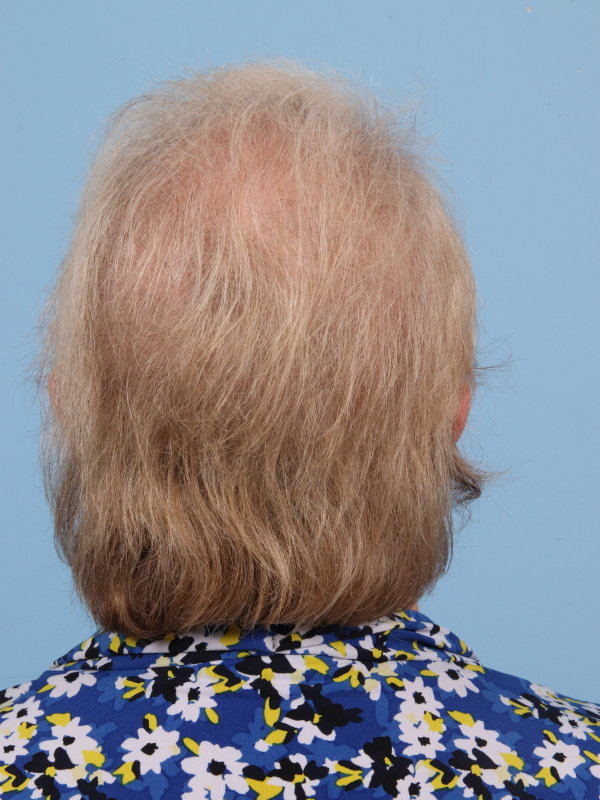 Hair Restoration Patient Photo - Case 14348 - after view-3