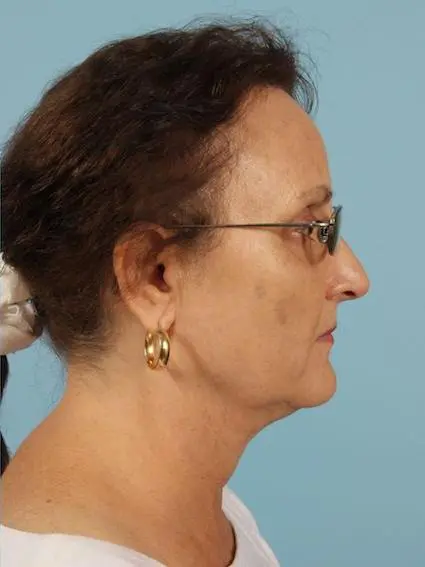 Kybella Patient Photo - Case 14404 - after view-2