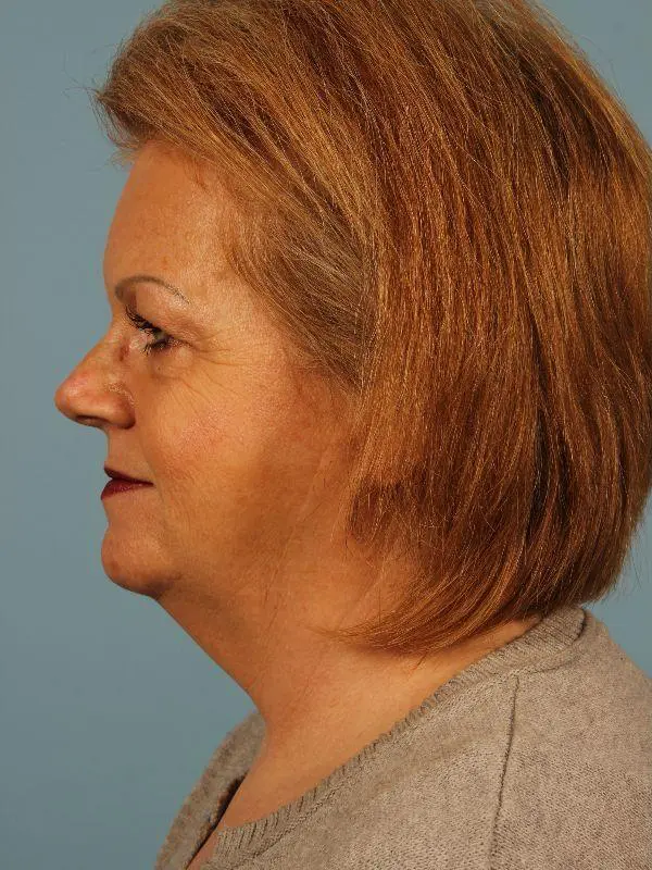 Kybella Patient Photo - Case 14435 - before view-1