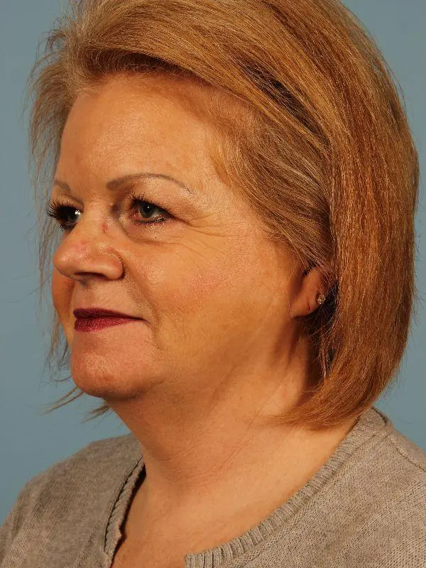 Kybella Patient Photo - Case 14435 - before view-2