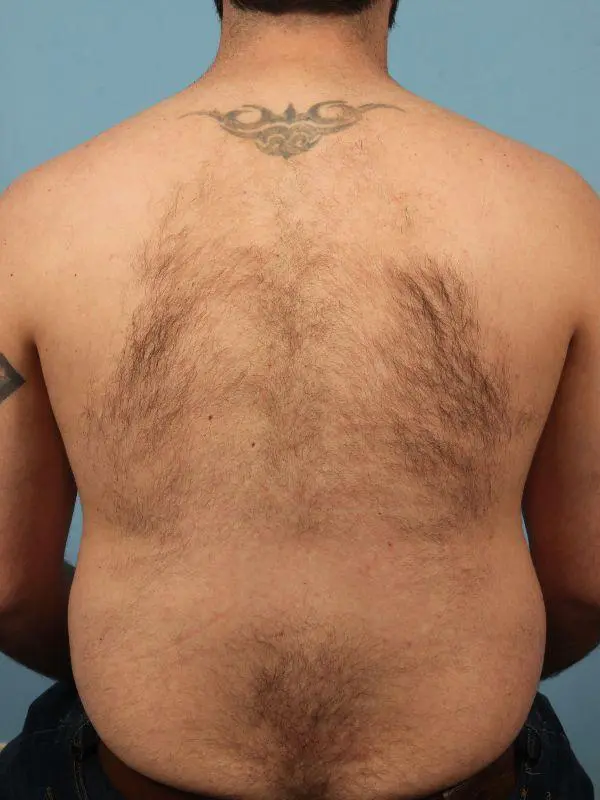 Laser Hair Reduction Patient Photo - Case 14452 - before view-