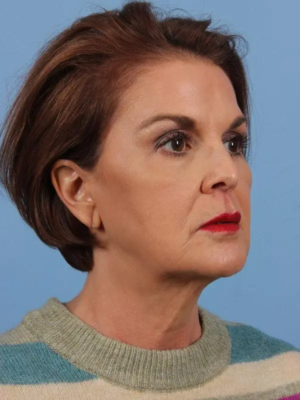 Injectable Fillers Patient Photo - Case 15032 - after view-4