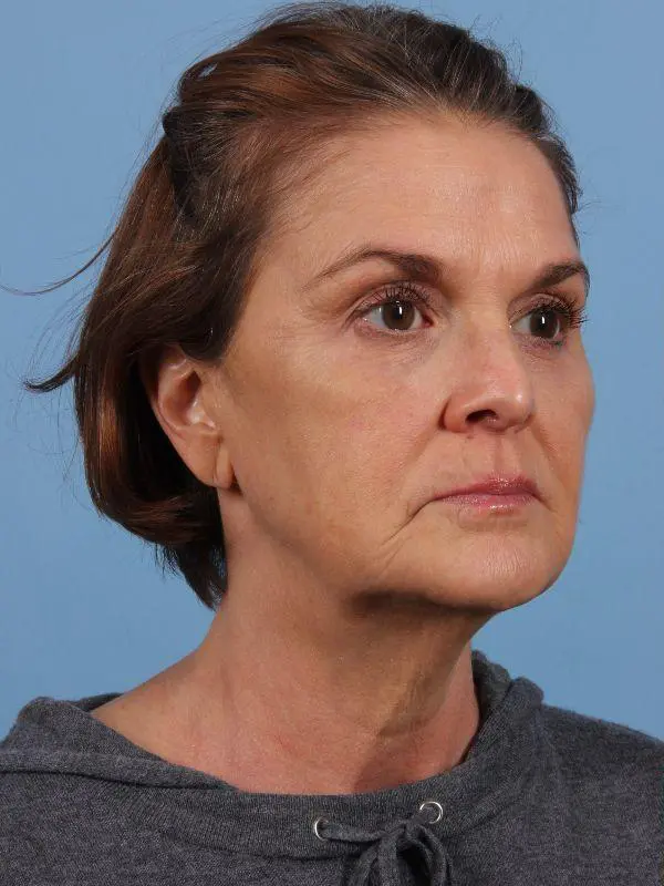 Injectable Fillers Patient Photo - Case 15032 - before view-4